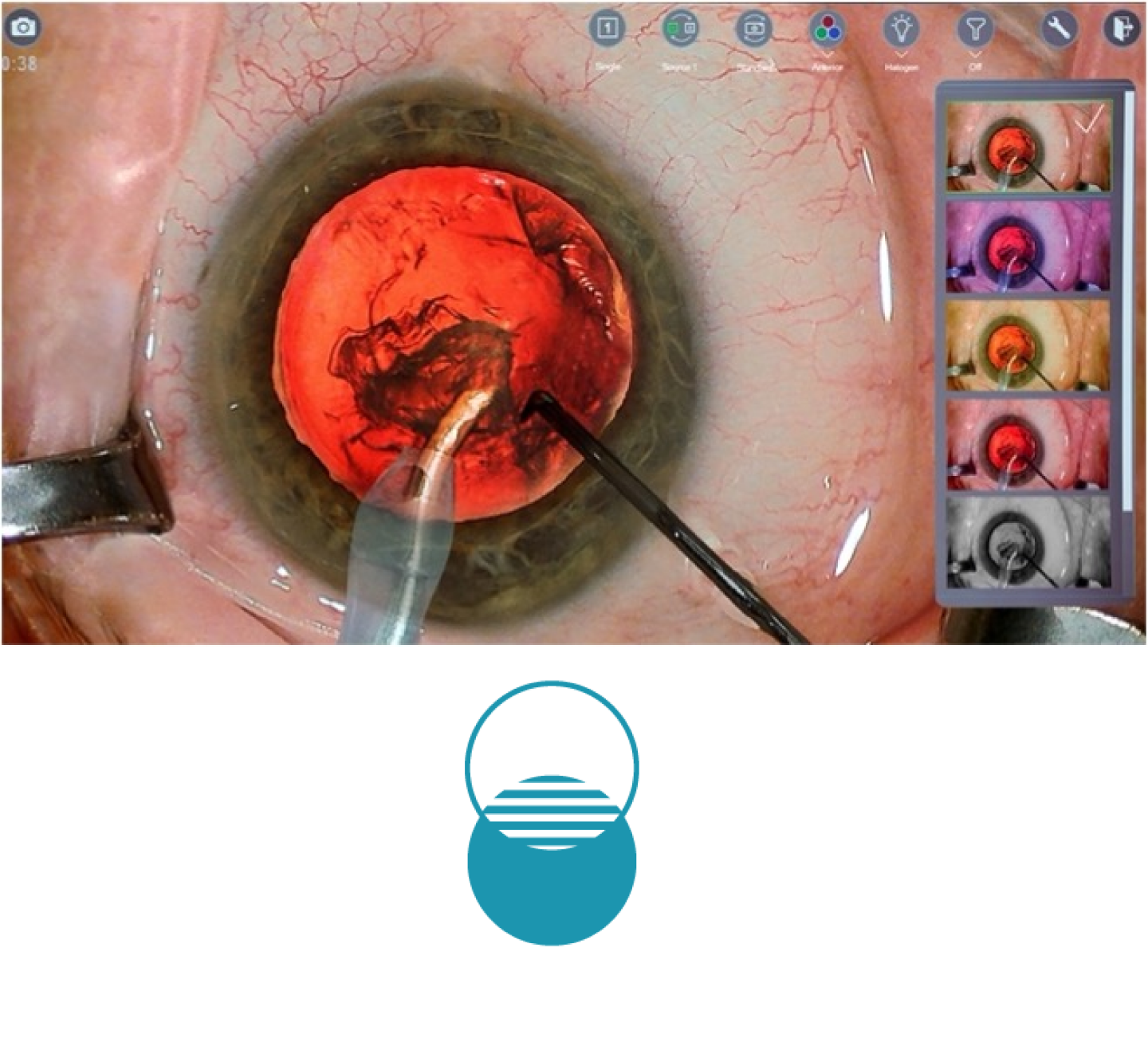 手術中の目のクローズアップ画像、画面には手術道具が表示されている。 画面右側のサムネイルには、NGENUITY 3Dビジュアリゼーションシステムで利用できる様々なカラーフィルターが表示されている